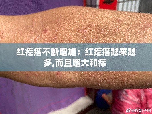 红疙瘩不断增加:红疙瘩越来越多,而且增大和痒