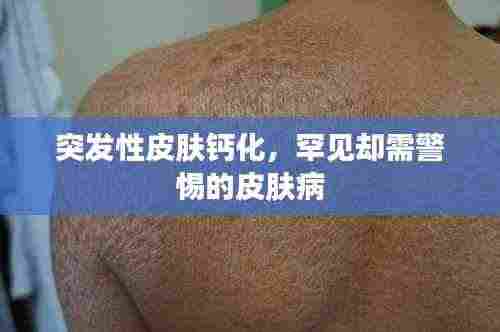 突发性皮肤钙化,罕见却需警惕的皮肤病